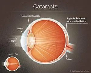 cataracts diagram