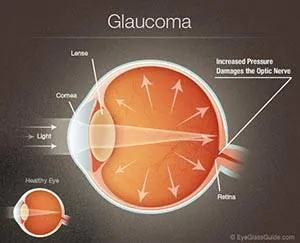glaucoma diagram