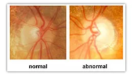 Glaucoma 20Eye 20Diagram